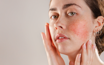Tu piel habla por ti: lo que hay detrás de una piel reactiva, con acné, eczemas o rosácea